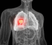 lung cancer